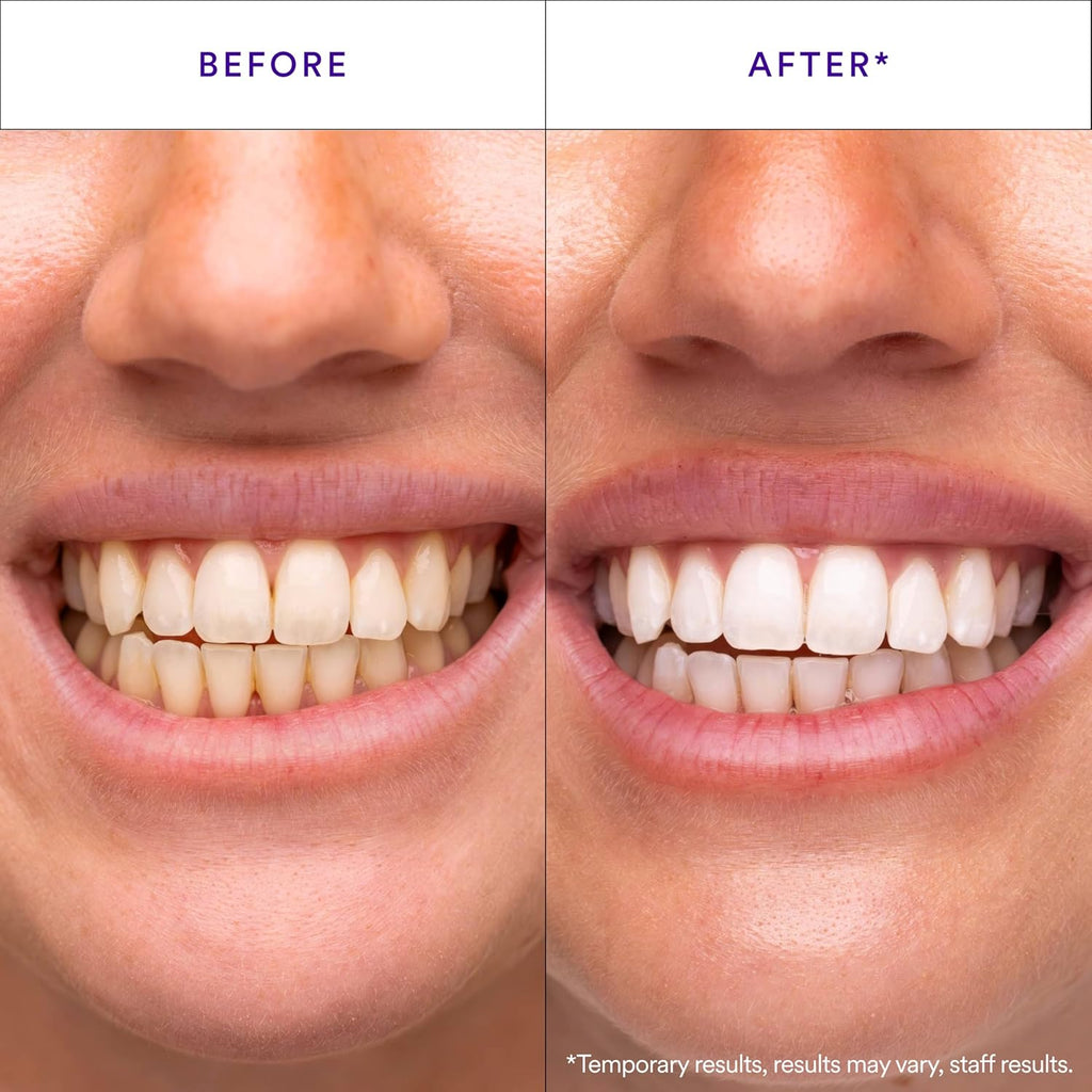 V34 Whitening Strips, Teeth Whitening Strips, Purple Tooth Whitening, Purple V34 Whitening Strips, Tooth Stain Treatment, Combining Whitening and Colour Correction