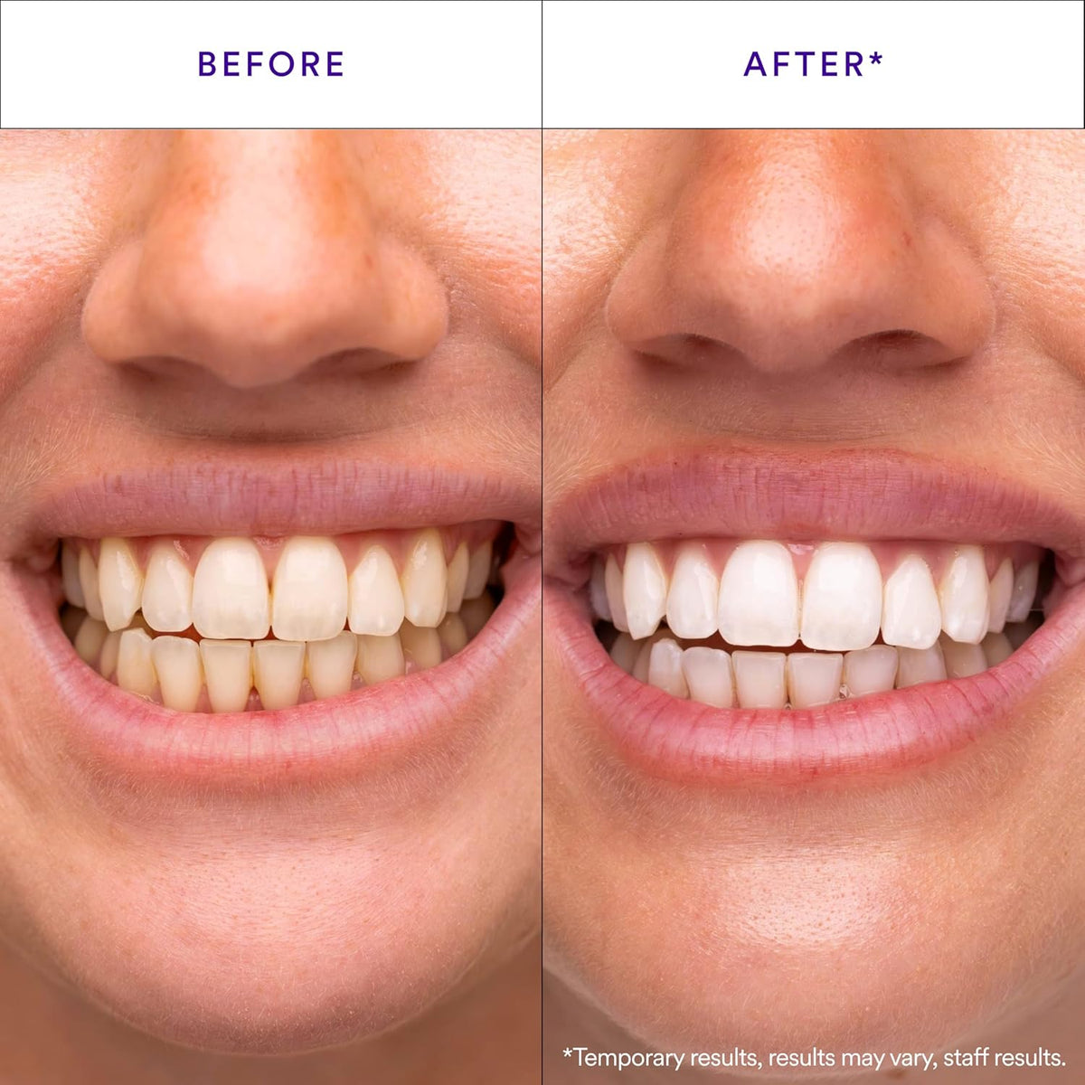V34 Whitening Strips, Teeth Whitening Strips, Purple Tooth Whitening, Purple V34 Whitening Strips, Tooth Stain Treatment, Combining Whitening and Colour Correction
